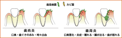 歯肉炎と歯周炎